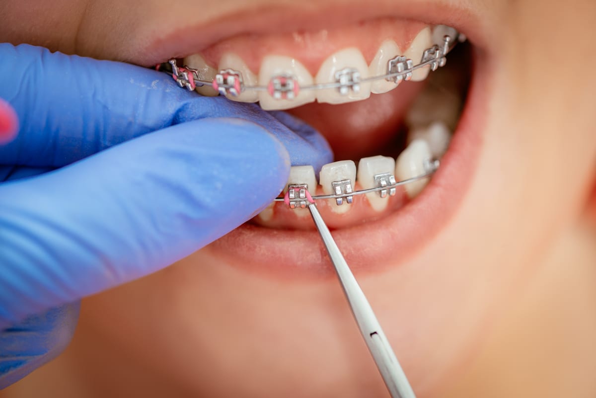 Dental Abscess in Renton WA: Signs You Need Help Today